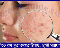 শীতে ব্রণ দূর করার উপায়। শীতে ব্রণের সমস্যার স্থায়ী সমাধান