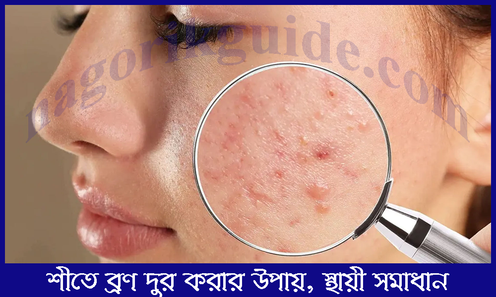 শীতে ব্রণ দূর করার উপায়। শীতে ব্রণের সমস্যার স্থায়ী সমাধান