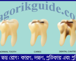 দাঁতের ক্ষয় রোগ: কারণ, লক্ষণ, প্রতিকার এবং প্রতিরোধ