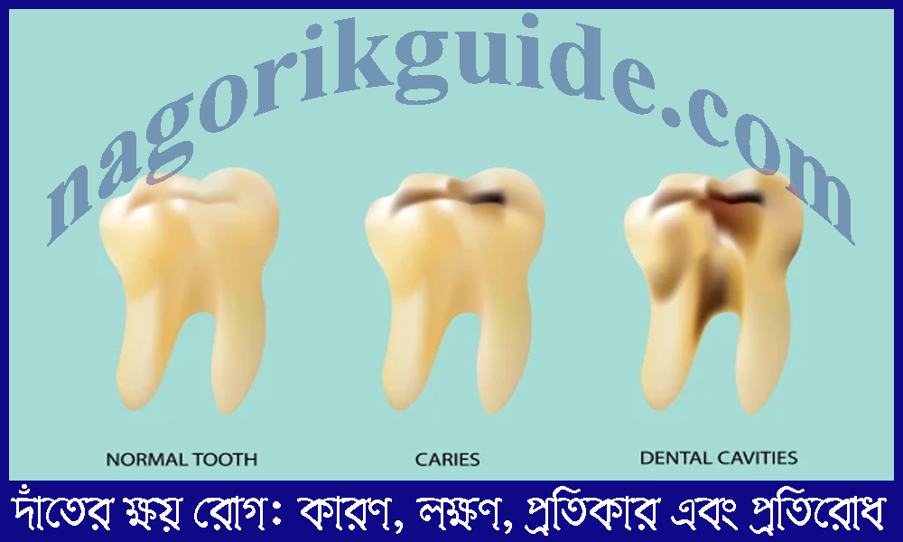 দাঁতের ক্ষয় রোগ: কারণ, লক্ষণ, প্রতিকার এবং প্রতিরোধ 1 দাঁতের ক্ষয় রোগ: কারণ, লক্ষণ, প্রতিকার এবং প্রতিরোধ