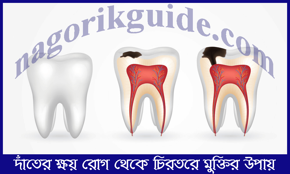 দাঁতের ক্ষয় রোগ থেকে চিরতরে মুক্তির উপায়