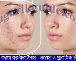 ব্রণ দূর করার কার্যকর উপায় : ঘরোয়া ও প্রাকৃতিক চিকিৎসা ব্রণ দূর করার কার্যকর উপায়