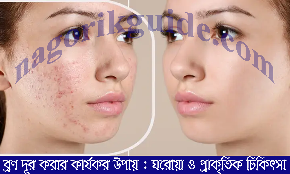 ব্রণ দূর করার কার্যকর উপায়