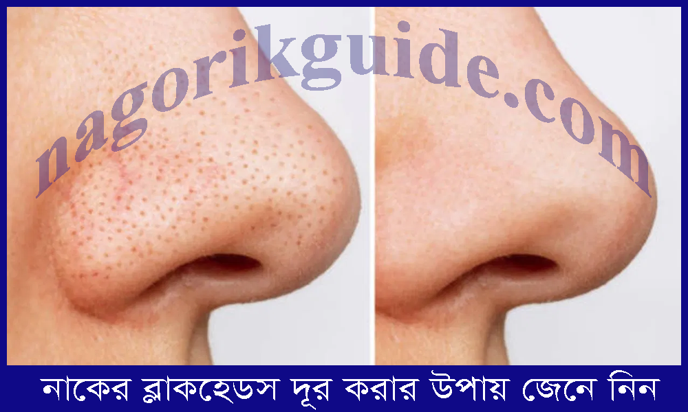 নাকের ব্ল্যাকহেডস দূর করার উপায়