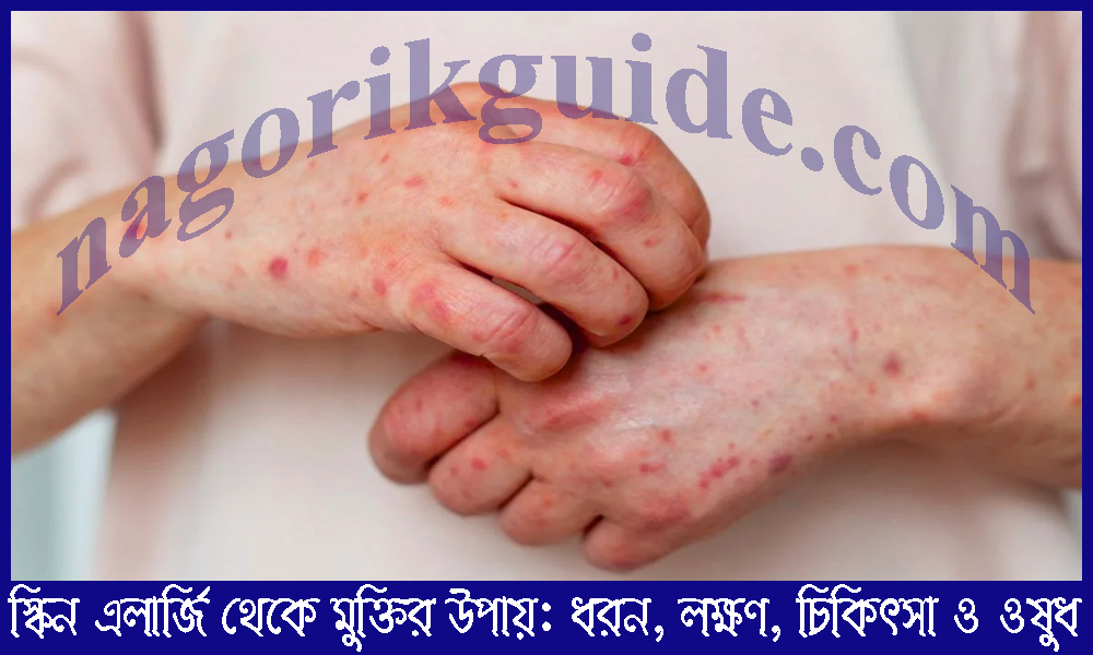 স্কিন এলার্জি থেকে মুক্তির উপায়: ধরন, লক্ষণ, চিকিৎসা ও ওষুধ