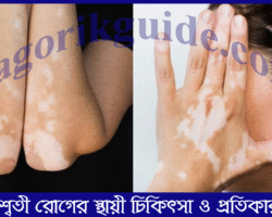 শ্বেতী রোগের স্থায়ী চিকিৎসা ও প্রতিকার শ্বেতী রোগের স্থায়ী চিকিৎসা ও প্রতিকার