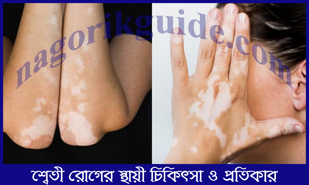 শ্বেতী রোগের স্থায়ী চিকিৎসা ও প্রতিকার