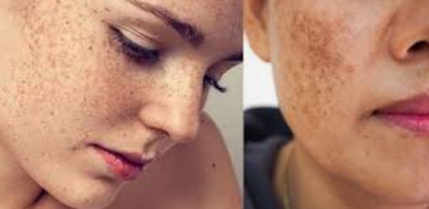 কালো দাগ ও মেছতা দূর করার ভেষজ চিকিৎসা