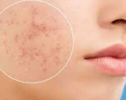 কালো দাগ ও মেছতা দূর করার ভেষজ চিকিৎসা