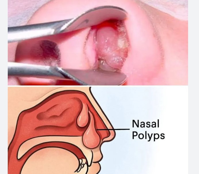 বিনা অপারেশনে নাকের পলিপাস চিকিৎসা